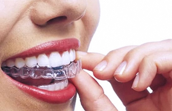 съемные брекеты